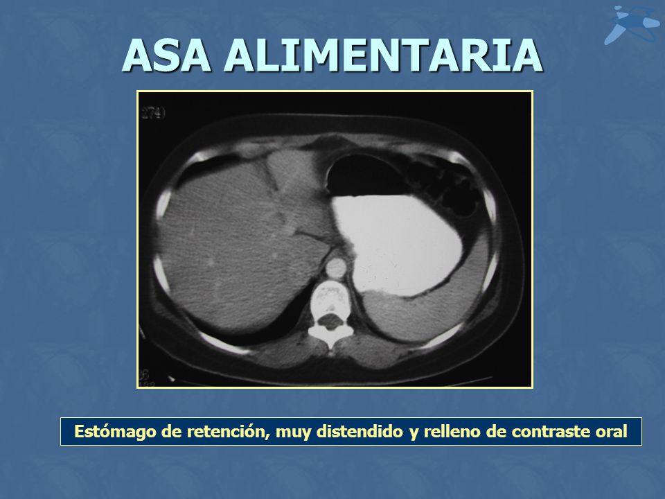 Estómago de retención, muy distendido y relleno de contraste oral