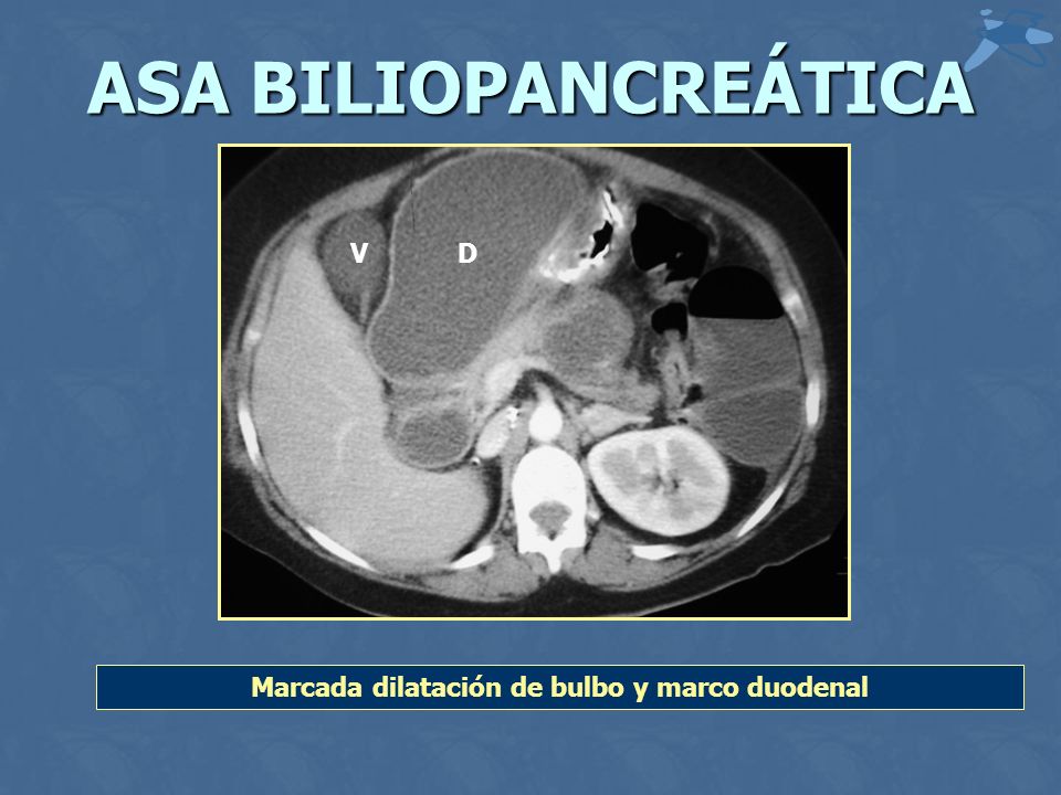 Marcada dilatación de bulbo y marco duodenal