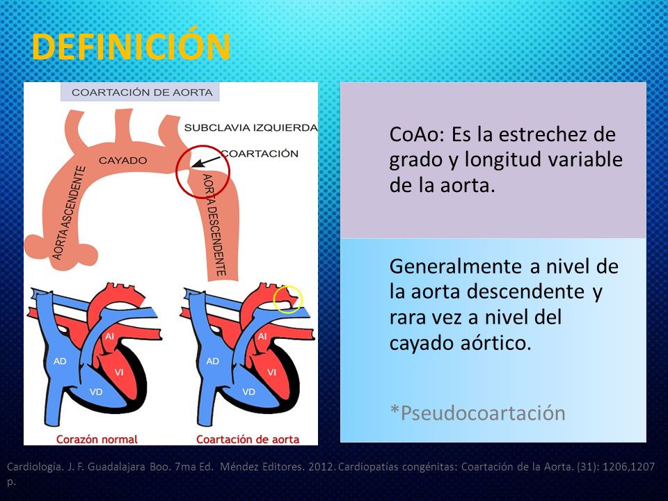DEFINICIÓN CoAo: Es la estrechez de grado y longitud variable de la aorta.