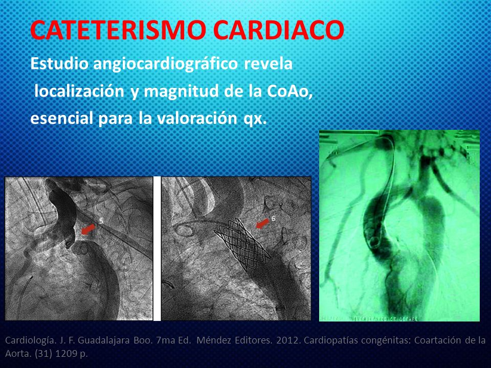 CATETERISMO CARDIACO Estudio angiocardiográfico revela localización y magnitud de la CoAo, esencial para la valoración qx.