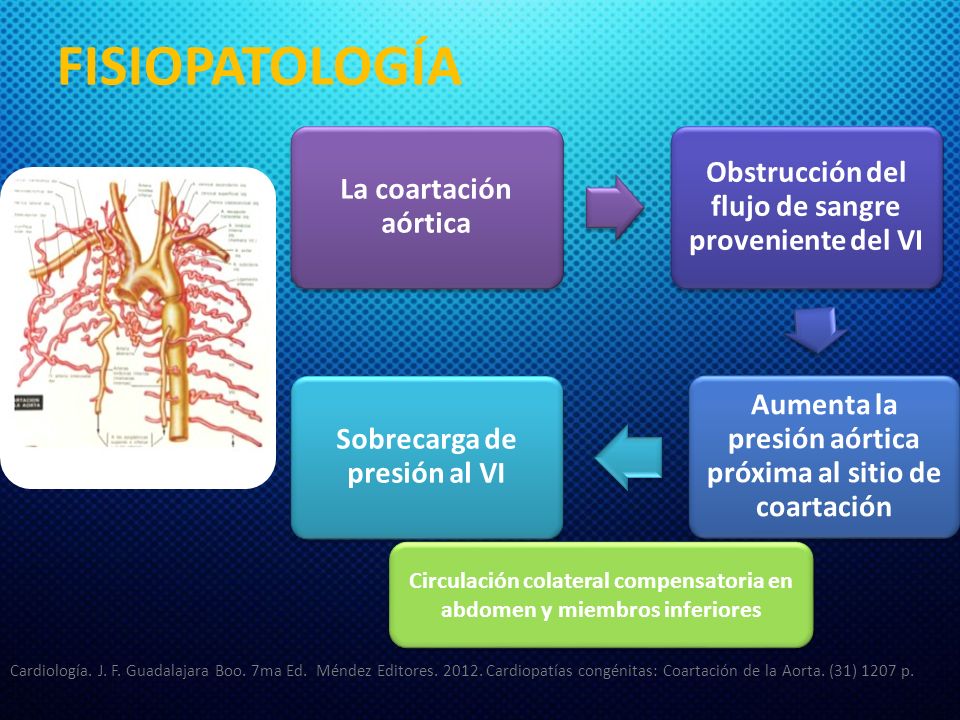 FISIOPATOLOGÍA La coartación aórtica. Obstrucción del flujo de sangre proveniente del VI.