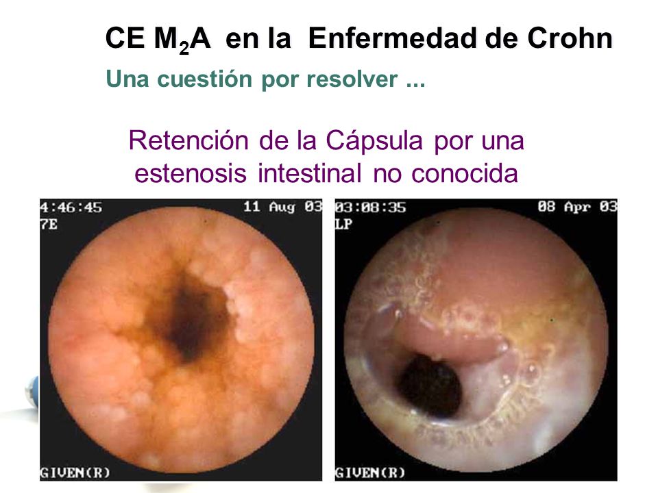 Retención de la Cápsula por una estenosis intestinal no conocida