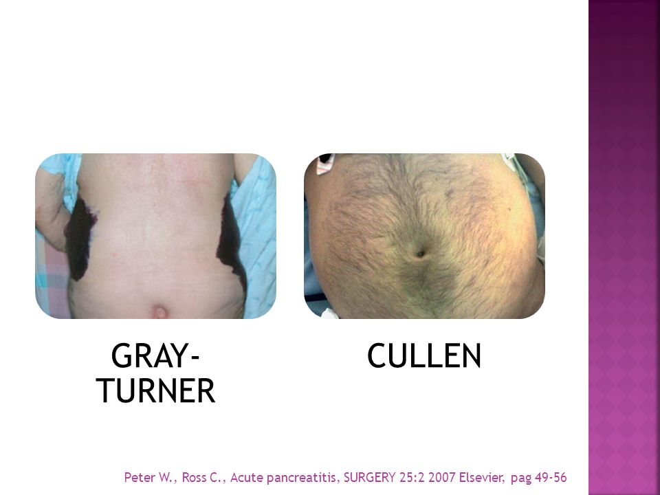 GRAY-TURNER CULLEN Peter W., Ross C., Acute pancreatitis, SURGERY 25: Elsevier, pag 49-56