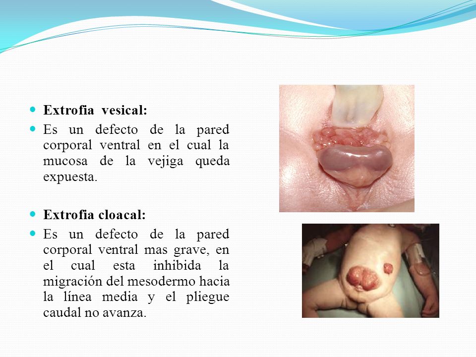Extrofia vesical: Es un defecto de la pared corporal ventral en el cual la mucosa de la vejiga queda expuesta.