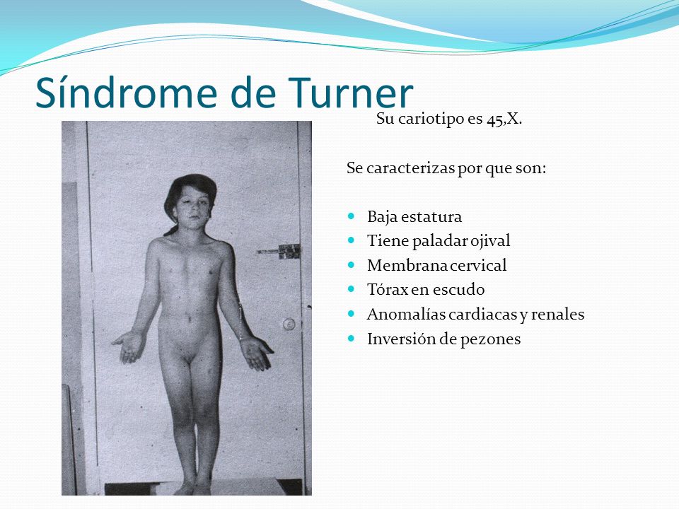 Síndrome de Turner Su cariotipo es 45,X. Se caracterizas por que son: