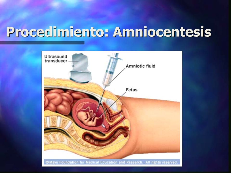 Procedimiento: Amniocentesis