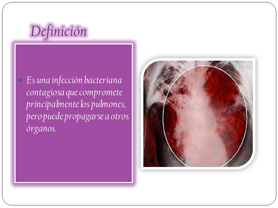 Definición Es una infección bacteriana contagiosa que compromete principalmente los pulmones, pero puede propagarse a otros órganos.