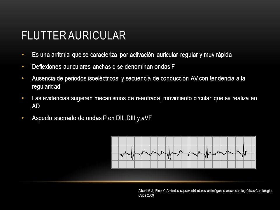 Flutter auricular Es una arritmia que se caracteriza por activación auricular regular y muy rápida.