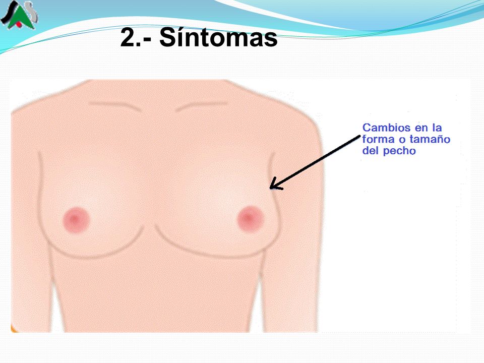 2.- Síntomas La forma más común de detectar este padecimiento es cuando tú misma observas cambios físicos en el aspecto de los pechos.