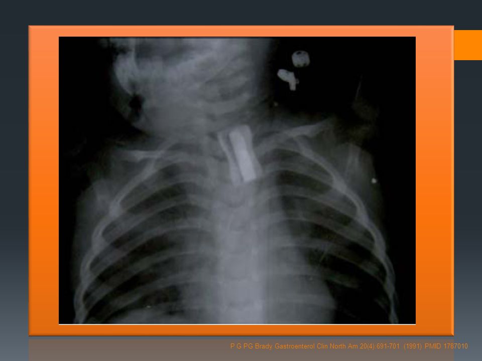 P G PG Brady Gastroenterol Clin North Am 20(4): (1991) PMID