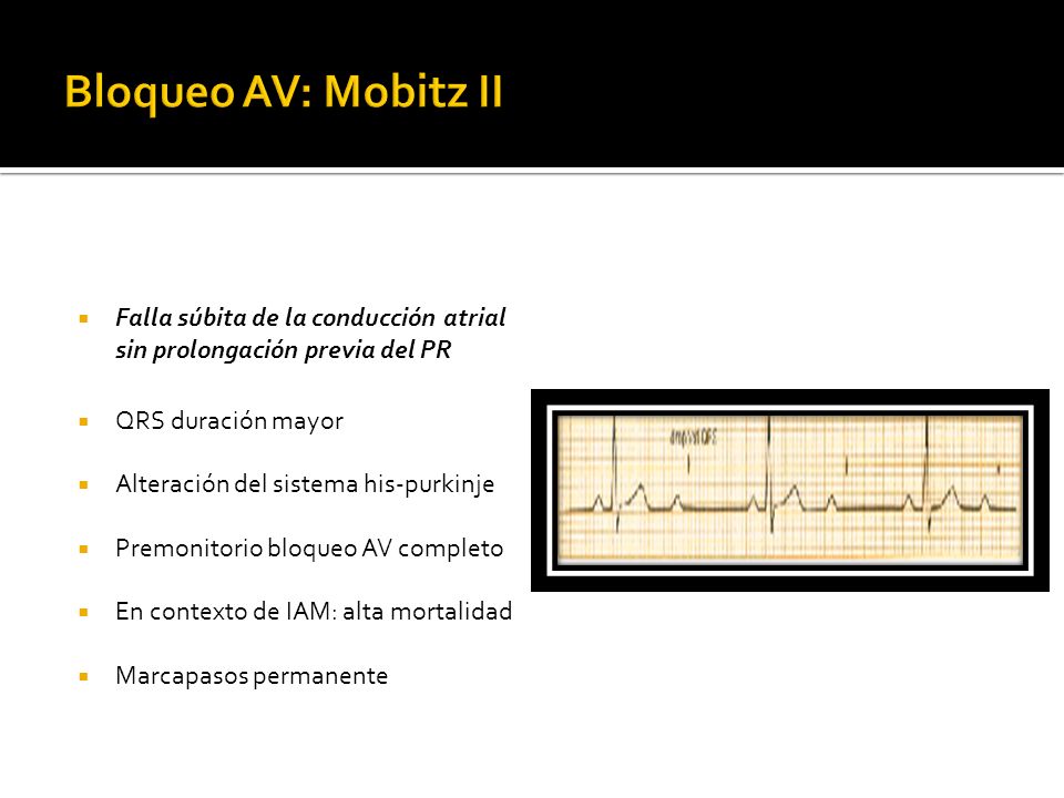 Bloqueo AV: Mobitz II Falla súbita de la conducción atrial sin prolongación previa del PR. QRS duración mayor.