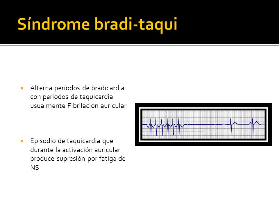 Síndrome bradi-taqui Alterna períodos de bradicardia con periodos de taquicardia usualmente Fibrilación auricular.