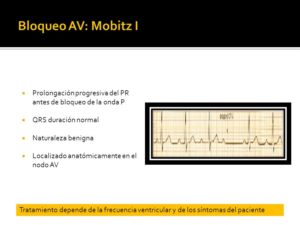 Bloqueo AV: Mobitz I Prolongación progresiva del PR antes de bloqueo de la onda P. QRS duración normal.