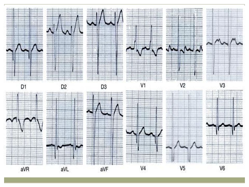 EKG: px con CIV HPA RS, FC 120 HBV R altas en V1-2, sobre carga de dicha cavidad y de ventriculo izq ondas R altas en V5-6