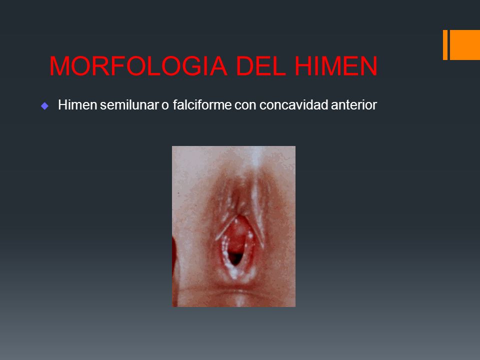 MORFOLOGIA DEL HIMEN Himen semilunar o falciforme con concavidad anterior