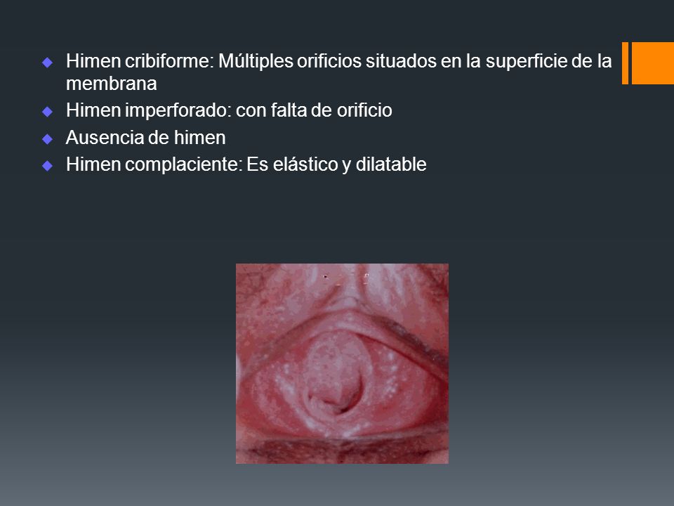 Himen cribiforme: Múltiples orificios situados en la superficie de la membrana