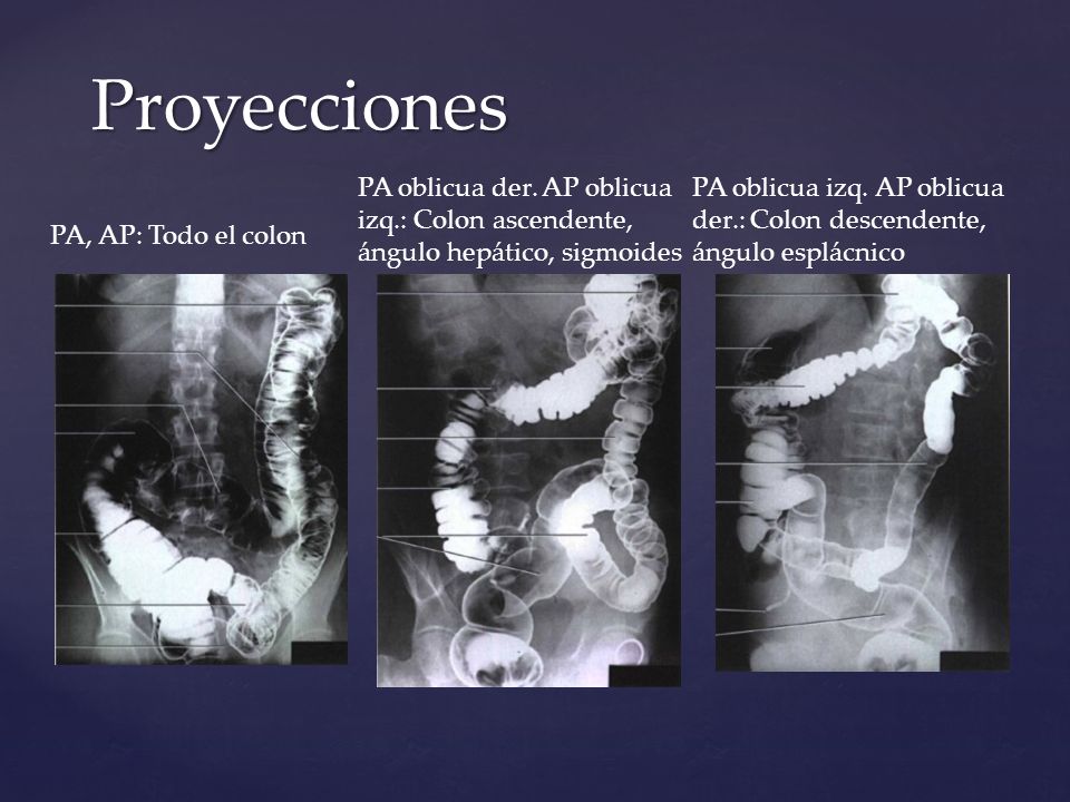 Proyecciones PA oblicua der. AP oblicua izq.: Colon ascendente, ángulo hepático, sigmoides.