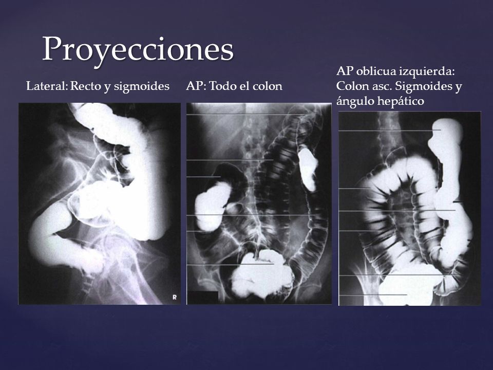 Proyecciones AP oblicua izquierda: Colon asc. Sigmoides y ángulo hepático. Lateral: Recto y sigmoides.