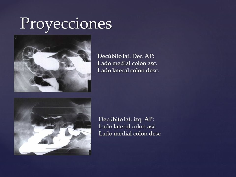 Proyecciones Decúbito lat. Der. AP: Lado medial colon asc. Lado lateral colon desc.