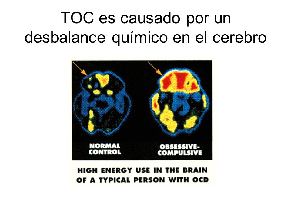 TOC es causado por un desbalance químico en el cerebro