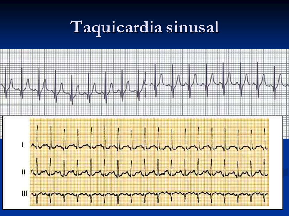 Taquicardia sinusal Es el resultado de la respuesta a la estimulación simpática o a la depresión de la actividad vagal, con mayor automatismo del NS.