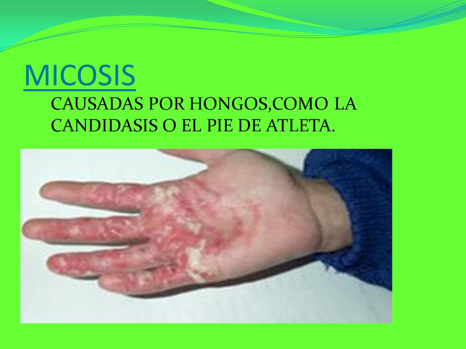 MICOSIS CAUSADAS POR HONGOS,COMO LA CANDIDASIS O EL PIE DE ATLETA.
