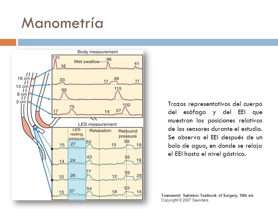 Manometría Trazos representativos del cuerpo del esófago y del EEI que muestran las posiciones relativas de los sensores durante el estudio.