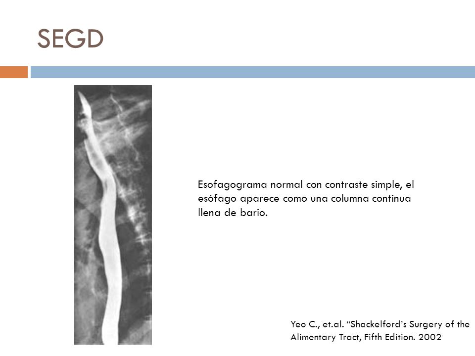 SEGD Esofagograma normal con contraste simple, el esófago aparece como una columna continua llena de bario.