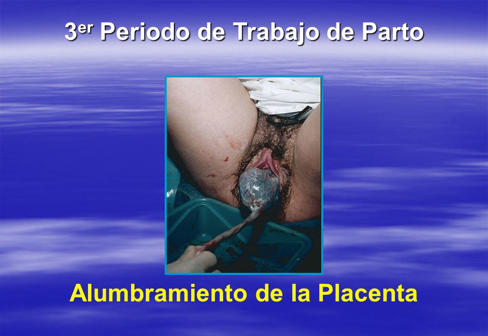 3er Periodo de Trabajo de Parto Alumbramiento de la Placenta