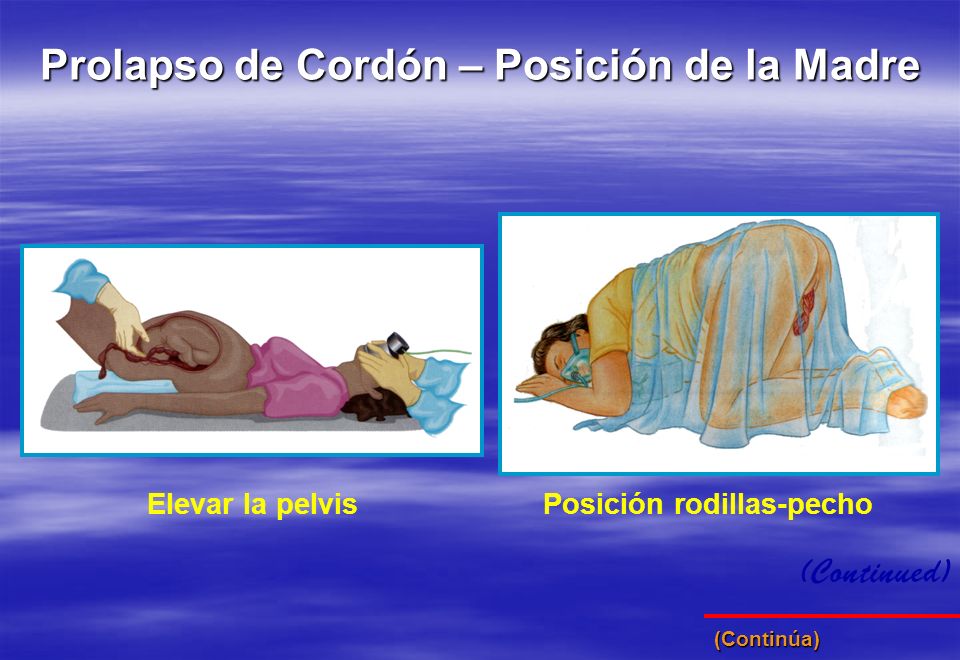 Prolapso de Cordón – Posición de la Madre Posición rodillas-pecho