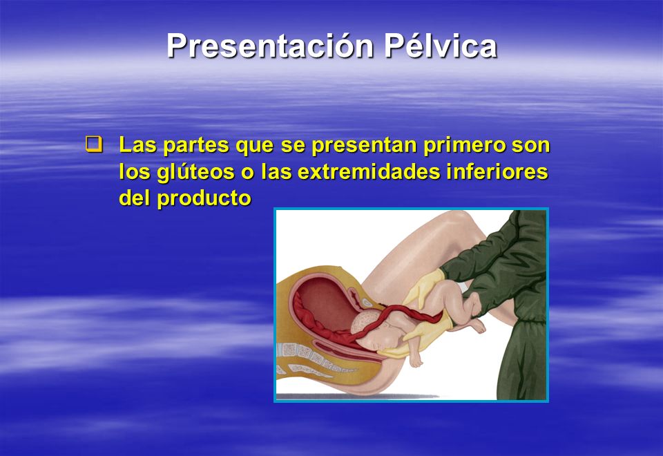Presentación Pélvica Las partes que se presentan primero son los glúteos o las extremidades inferiores del producto.