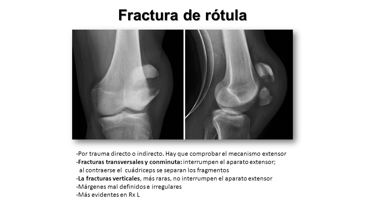 Fractura de rótula -Por trauma directo o indirecto. Hay que comprobar el mecanismo extensor.