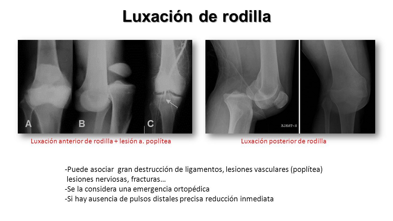 Luxación de rodilla Luxación anterior de rodilla + lesión a. poplítea. Luxación posterior de rodilla.