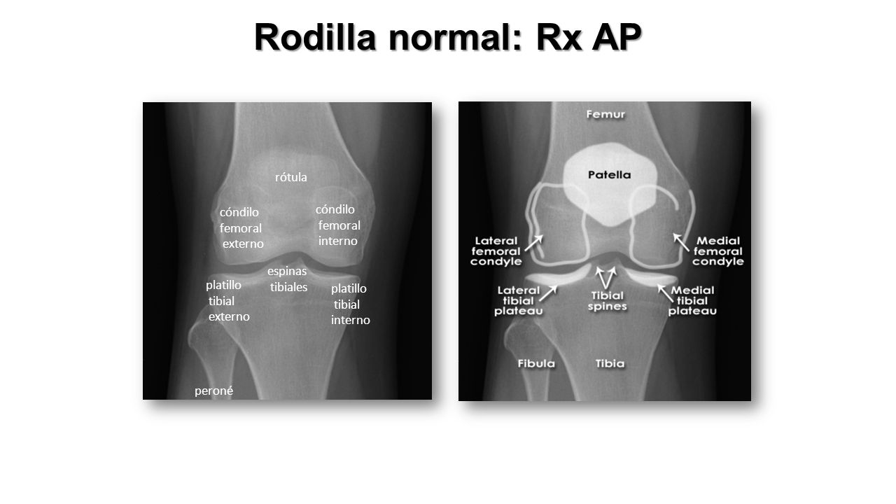 Rodilla normal: Rx AP rótula cóndilo femoral interno externo espinas
