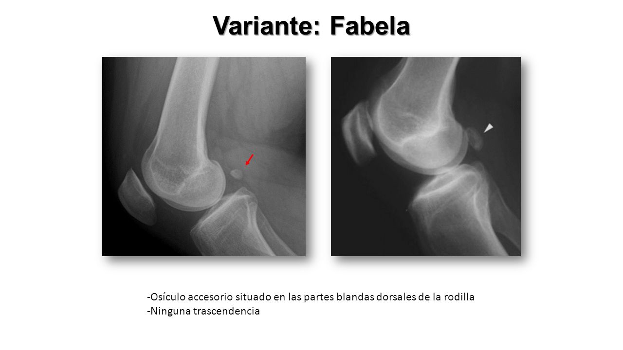 Variante: Fabela Osteosarcoma clásico, telangiectásico, parosteal, -Osículo accesorio situado en las partes blandas dorsales de la rodilla.