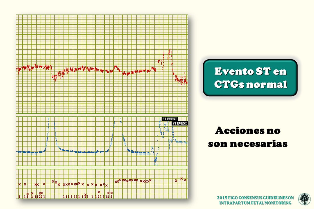 Evento ST en CTGs normal Acciones no son necesarias