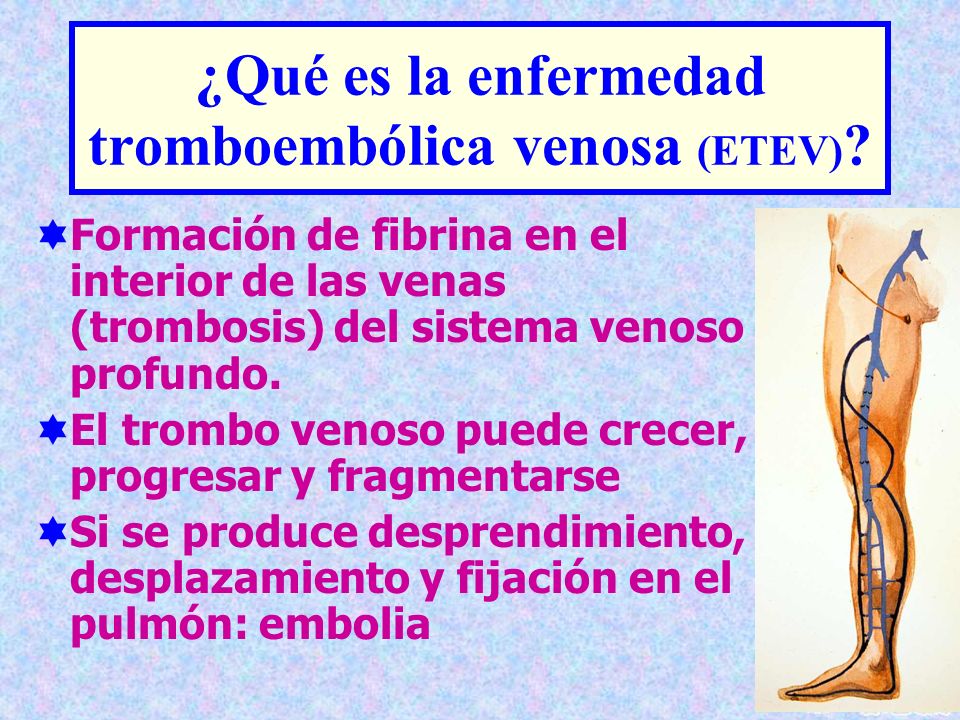 ¿Qué es la enfermedad tromboembólica venosa (ETEV)