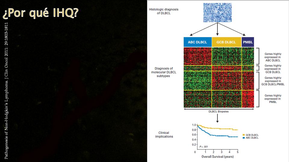 ¿Por qué IHQ Pathogenesis of Non-Hodgkin’s Lymphoma. J Clin Oncol 2011: 29: