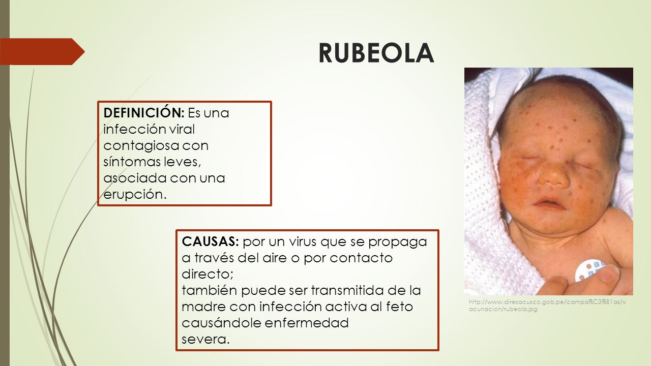 RUBEOLA DEFINICIÓN: Es una infección viral contagiosa con síntomas leves, asociada con una erupción.