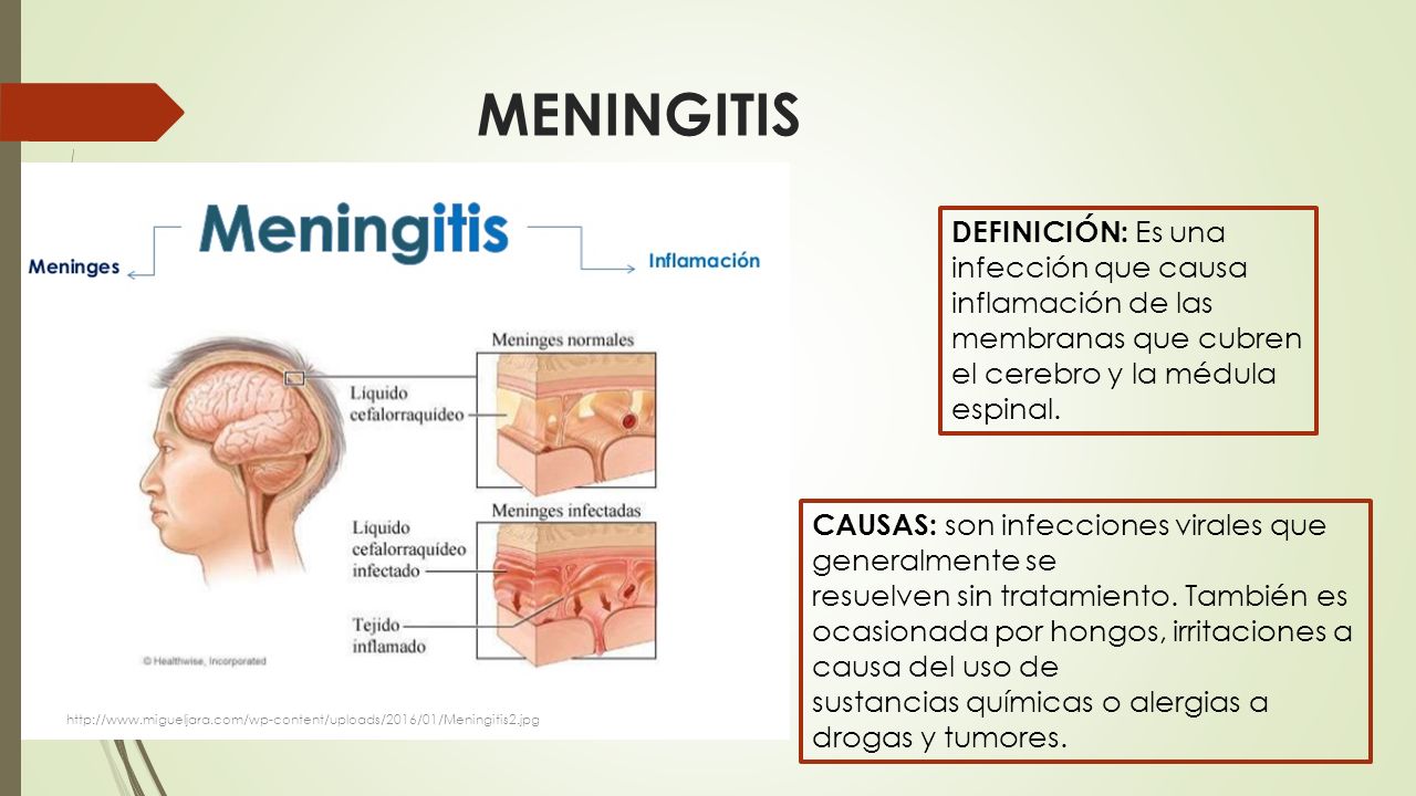 MENINGITIS DEFINICIÓN: Es una infección que causa inflamación de las membranas que cubren el cerebro y la médula.