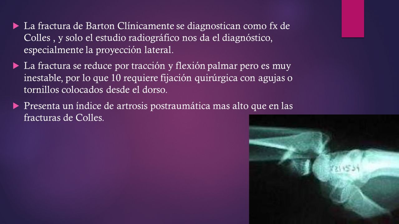 La fractura de Barton Clínicamente se diagnostican como fx de Colles , y solo el estudio radiográfico nos da el diagnóstico, especialmente la proyección lateral.