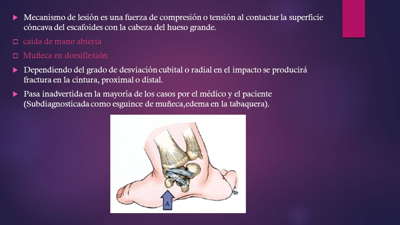 Mecanismo de lesión es una fuerza de compresión o tensión al contactar la superficie cóncava del escafoides con la cabeza del hueso grande.