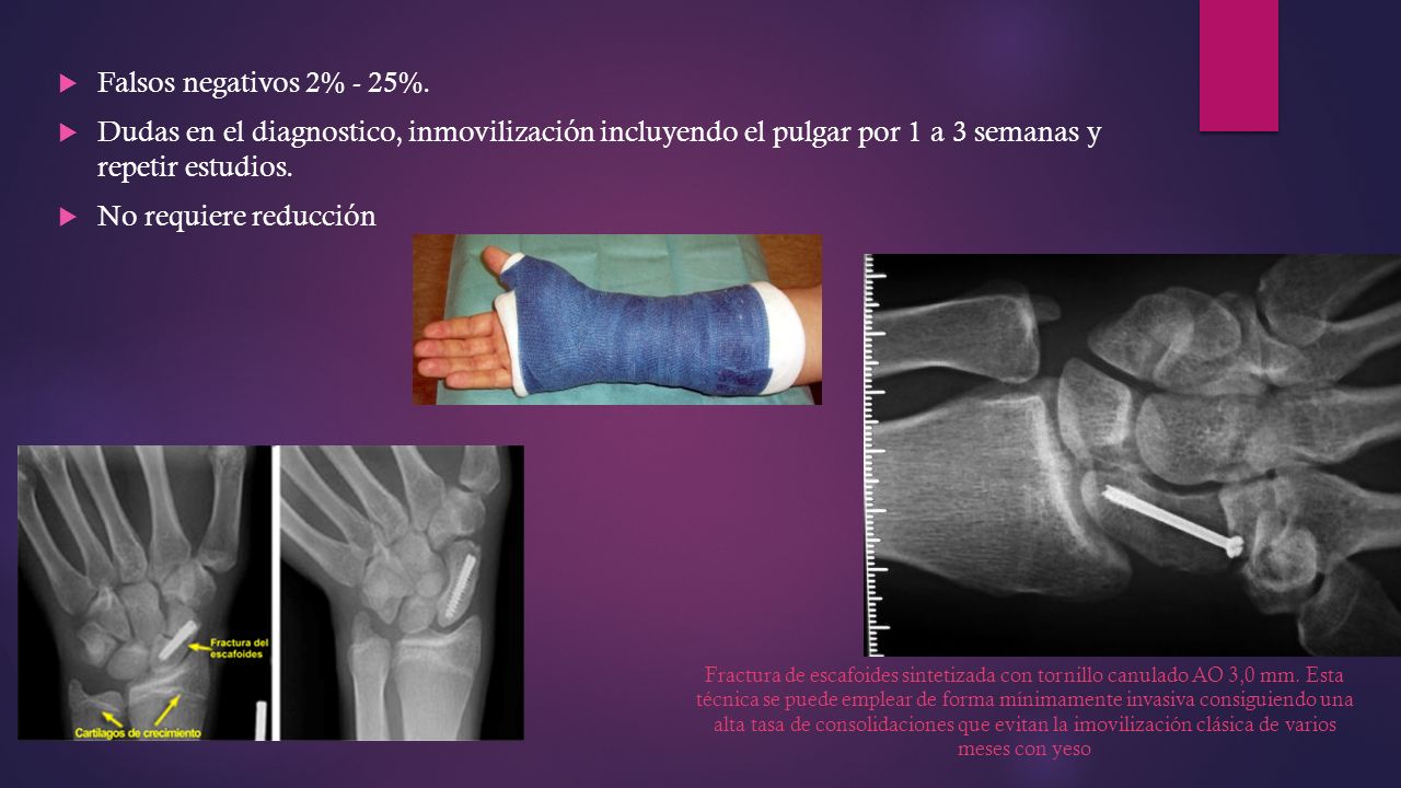 Falsos negativos 2% - 25%. Dudas en el diagnostico, inmovilización incluyendo el pulgar por 1 a 3 semanas y repetir estudios.