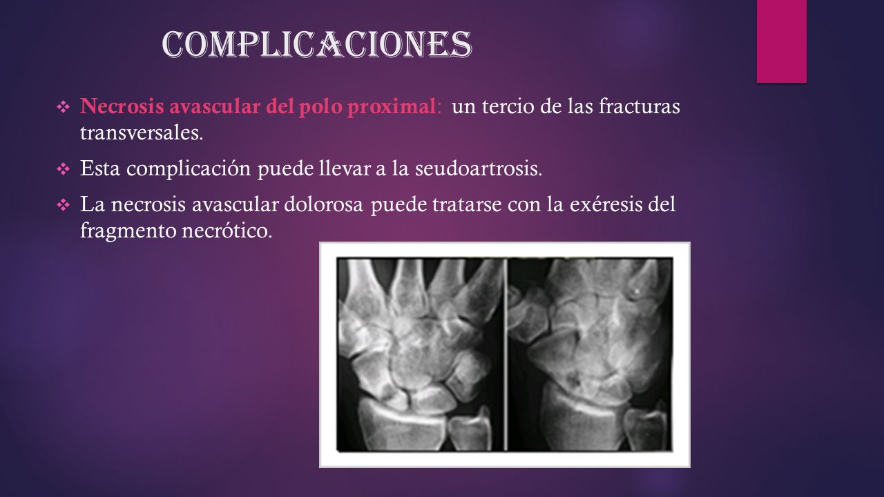Complicaciones Necrosis avascular del polo proximal: un tercio de las fracturas transversales. Esta complicación puede llevar a la seudoartrosis.