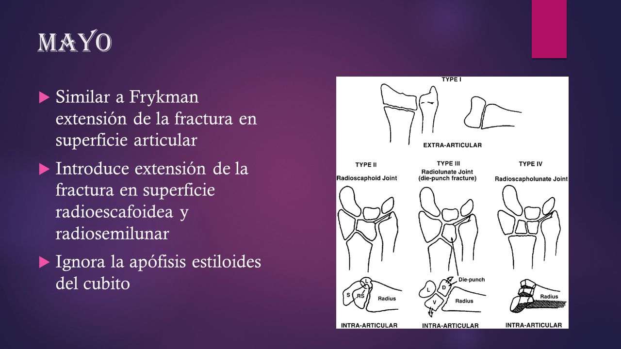 Mayo Similar a Frykman extensión de la fractura en superficie articular.