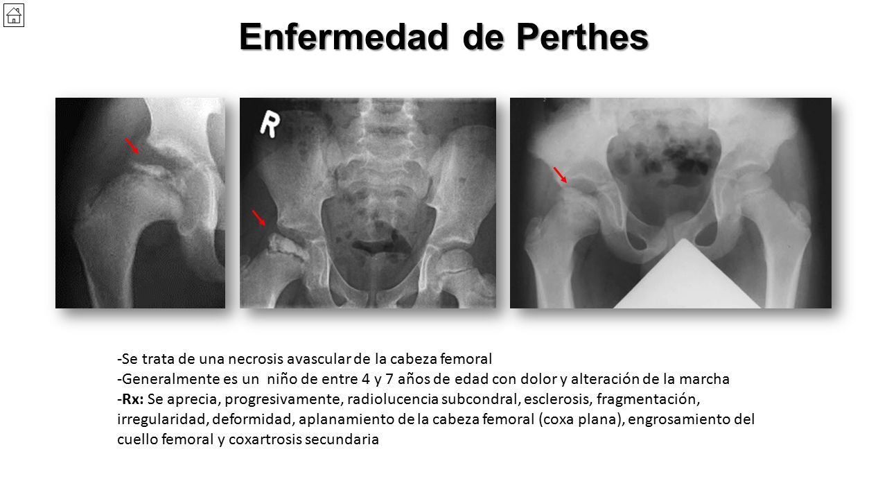 Enfermedad de Perthes Buscar luxación anterior de cadera. -Se trata de una necrosis avascular de la cabeza femoral.