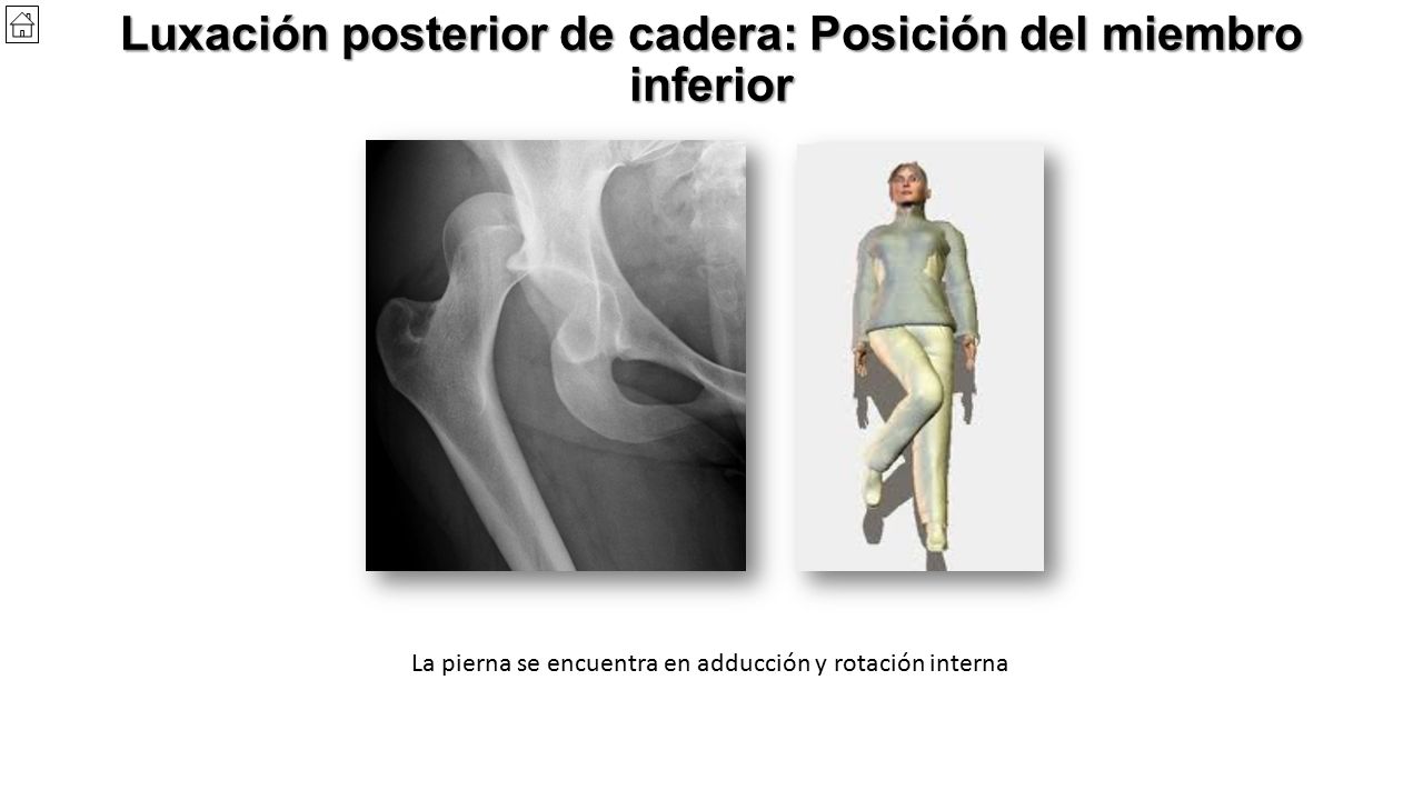 Luxación posterior de cadera: Posición del miembro inferior