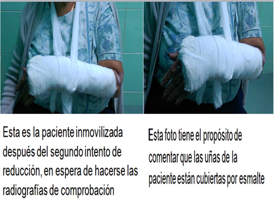 Aquí tenemos el propósito de mostrar que la paciente está con esmalte en las uñas que se le acaban de inmovilizar y es una de las recomendaciones que debe hacer su médico en ese momento que es retirar el esmalte de las uñas