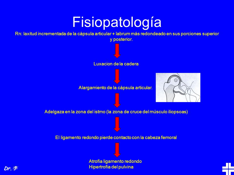 Fisiopatología Rn: laxitud incrementada de la cápsula articular + labrum más redondeado en sus porciones superior y posterior.
