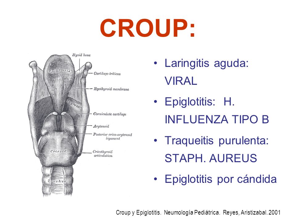 CROUP: Laringitis aguda: VIRAL Epiglotitis: H. INFLUENZA TIPO B